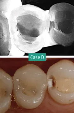 dental transillumination